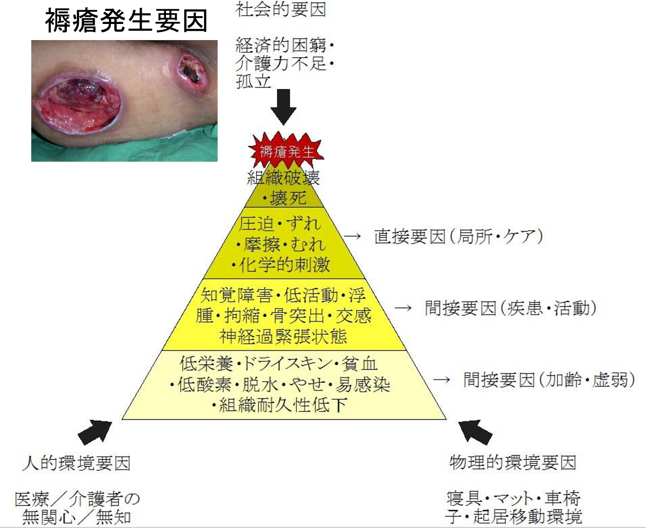 寝たきり老人さんの身体に起きていること ⑬ 褥瘡の発生１：褥瘡への認識